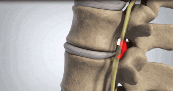 骨质增生|神经损伤|人工膝关节_网易订阅