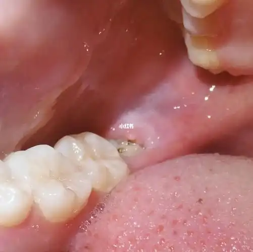 死了痛死了痛死了痛死了痛死了痛死了痛死了痛死了痛死了右侧智齿发炎