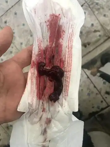 姨妈过了两天又出血了,大姨妈过了两天又出血