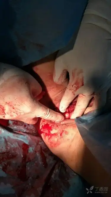 顺产阴道后壁所见,大家猜是什么