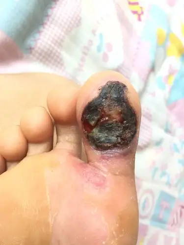 出院一周了,伤口为啥总是愈合不上?也没发炎,一个月能不能长好?