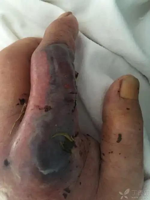 眼镜蛇咬伤 [病例帖]