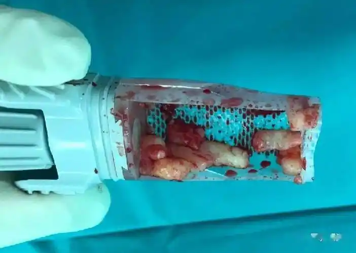 乳腺微创真空辅助乳腺肿物微创旋切术精准无痕当日出院