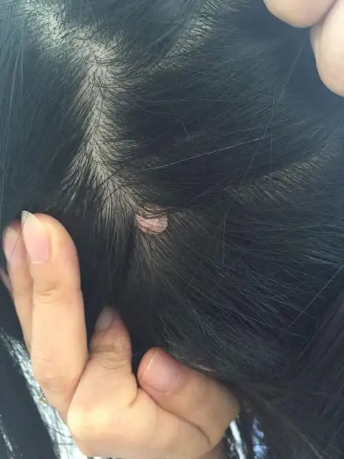 头皮上长了个疙瘩将近二十年了 不疼不痒 求解这是什么原因呢