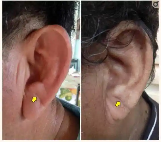 耳垂折痕,到底是不是心脏病的表征?