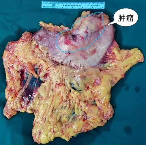 切除的全胃,可见肿瘤巨大.
