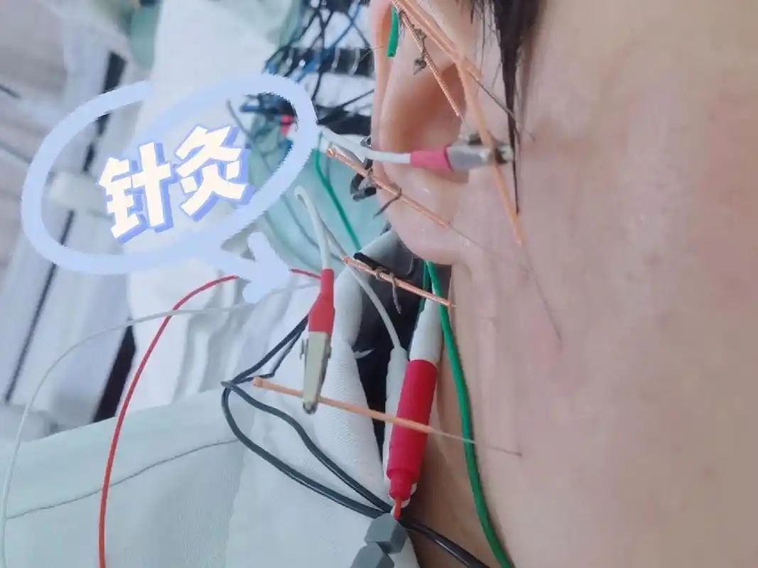 颞颌关节紊乱已经是第二次复发了,从咽炎—感冒—颞下颌关节炎,已经自