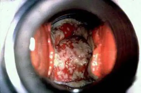 女性患妇科病频率比感冒高 嗜食甜食更易得妇科病