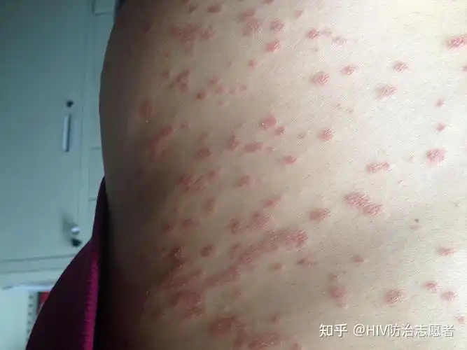 回答:起皮疹的话并不能够确认是艾滋病的,因为皮肤的疾病也是可以起