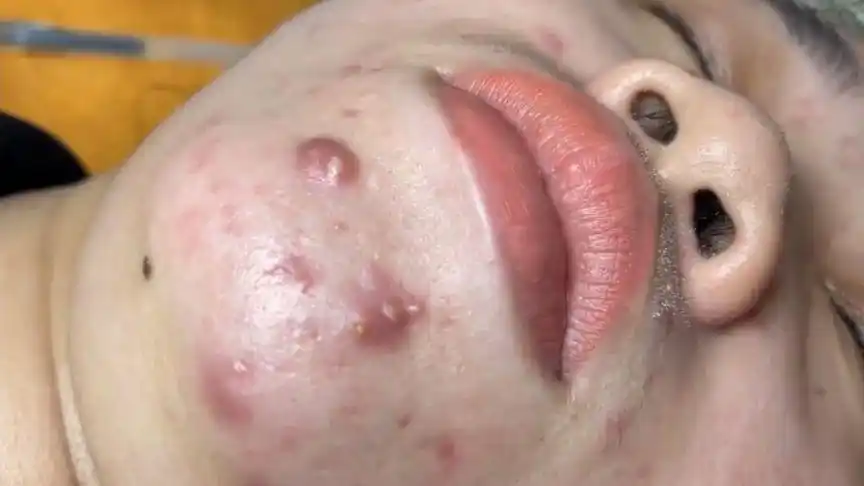 脓包型粉刺建议专业机构处理