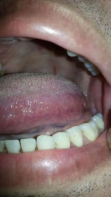 请帮忙看一下我这个口腔是不是艾滋病症状?