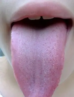 舌头发白有两种情况,一个是舌头淡白色,这个时候如果还出现有乏力