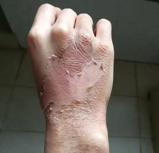 医生说没事,真皮层受伤恢复当中,色素沉着很正常,不用往上面涂抹东西