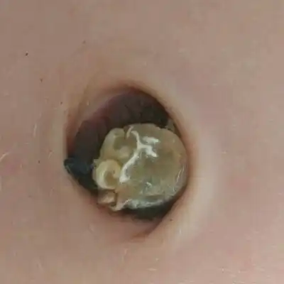 今天大小宝宝肚脐眼这样了?怎麼办?