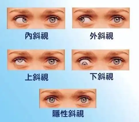 "虽然平时努力让自己假装不在意,但其实因为眼睛斜视一直都有点自卑