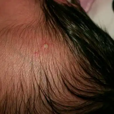 宝宝刚出生十几天头上起脓疱豆豆,怎麼处理?