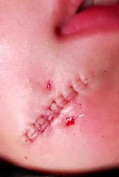 什么是超级减张精细缝合?_疤痕_如何预防_治疗方式 - 好大夫在线