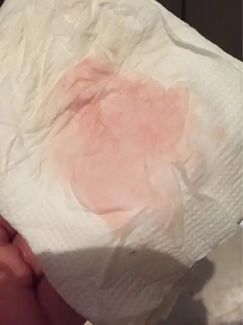 早孕37天,时不时流粉色液体,怎么破