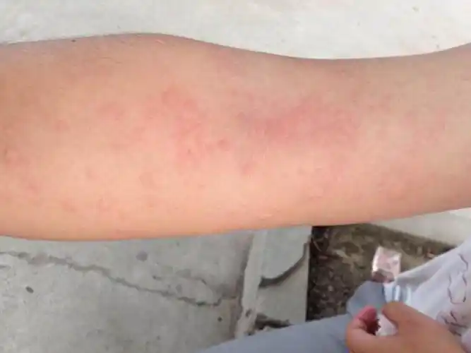 寒冷性荨麻疹手背皮肤病图片