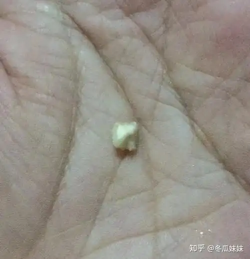 颌下腺结石要做手术吗?