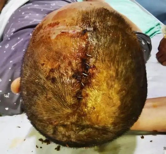 陈磊副主任医师谈了自己的心得:术前该病人顶部伤口缺损范围在2*2.