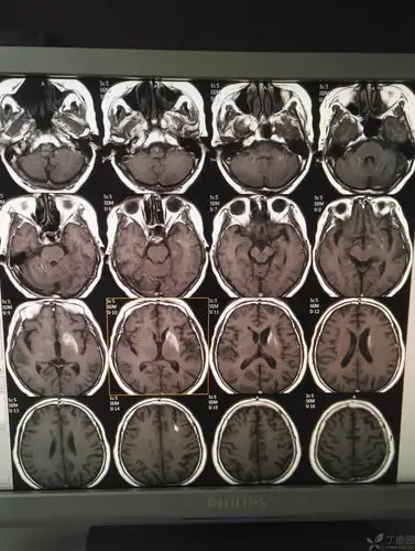 左侧基底节区普遍高密度影是什么呢 - 影像医学和核医学讨论版