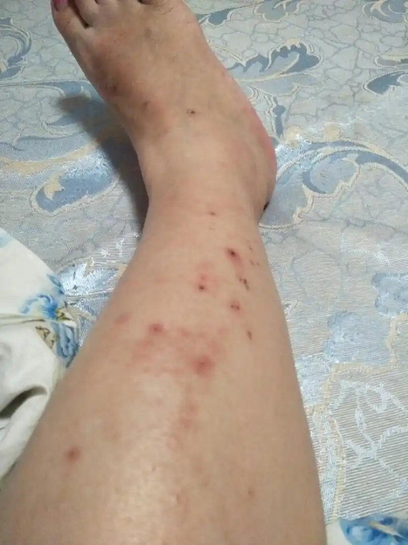 身体2个部位瘙痒,或许是糖尿病"信号",别以为是皮肤病  现在患糖尿病