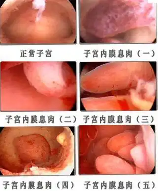 从宫颈口或阴道内发现软脆,易出血的息肉样肿物. 4.