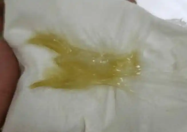 的分泌物变得异常增多等等,都有可能是宫颈引起发生病变而导致的现象