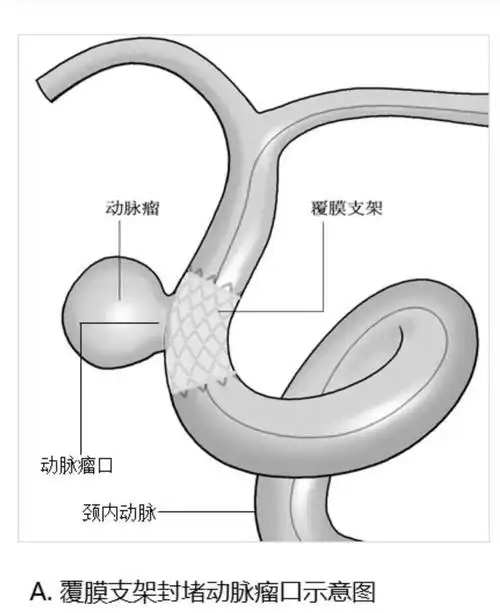 卒中小组讨论后决定立即进行覆膜支架置入术,重建血管壁,隔绝动脉瘤