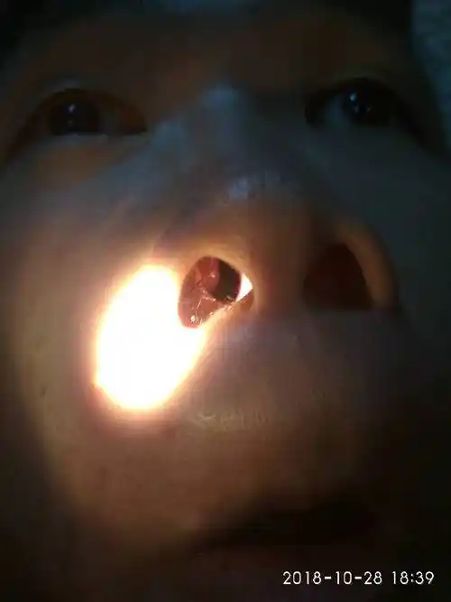 慢性鼻咽炎怎么治疗好?吃中药好还是手术好