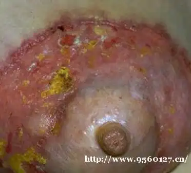 以上是   青岛百姓皮肤病医院就"三期梅毒症状"做的简单阐述