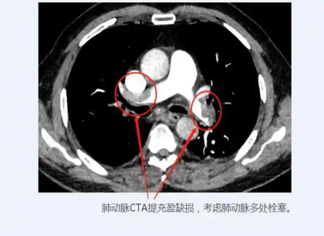 事不宜迟,许嗲嗲经绿色通道被快速送入放射影像科行肺动脉cta检查.