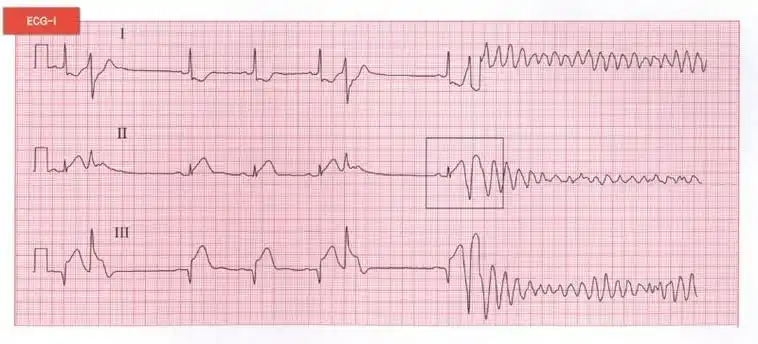 2021年临床执业医师实践技能模考卷第5套辅助检查心室颤动的心电图