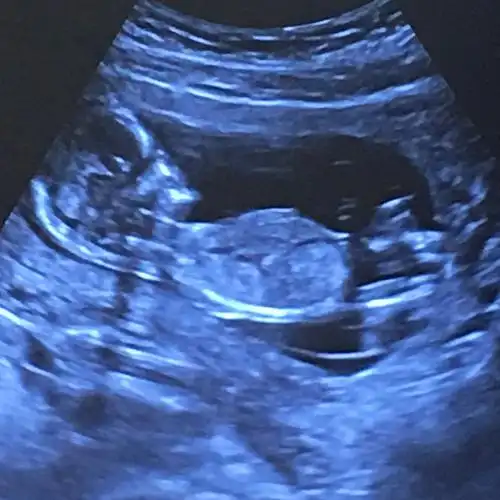 楼主 俊美来袭 孕14周lv.