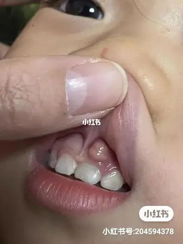 (下)两岁三个月宝宝外伤根尖周炎根管治疗