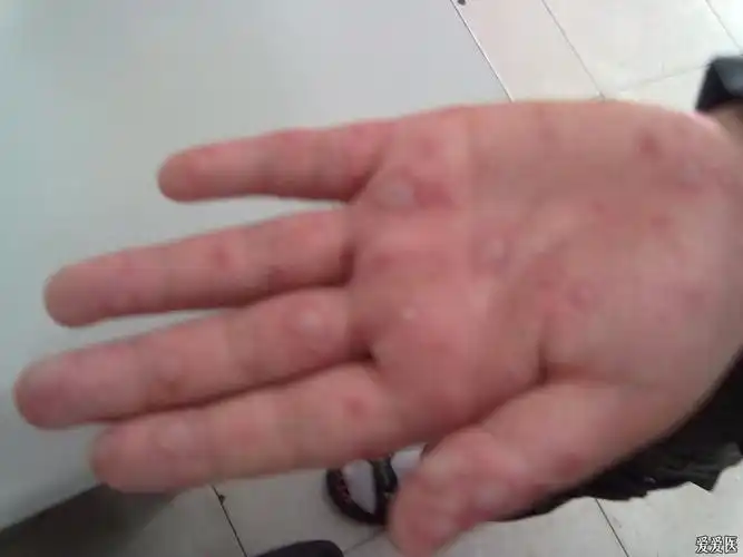 第一次见的双手掌水泡(有图)