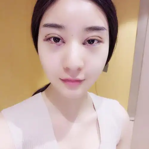 韩式开眼角_相关案例_新氧整形