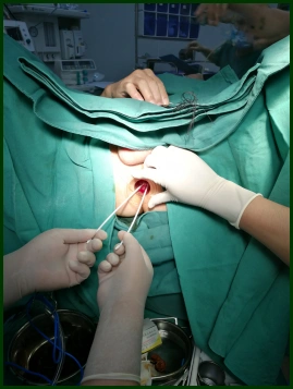 rph(最微创的痔疮手术)图示 - 好大夫在线