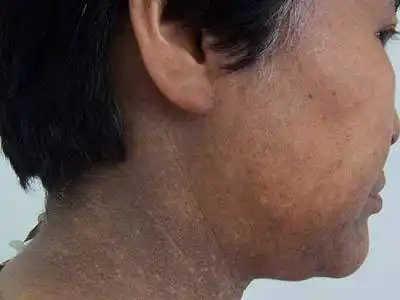 化妆品对黑变病的危害