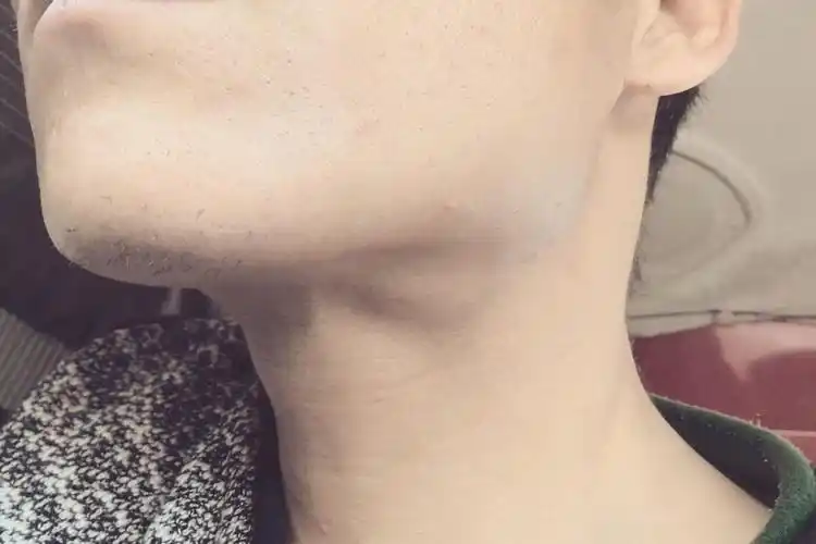 颈部淋巴结肿大