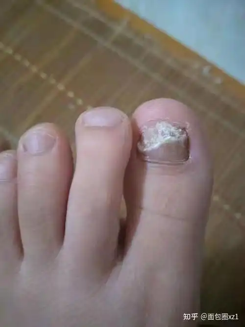 灰指甲早期症状是什么样子的?可以治好吗