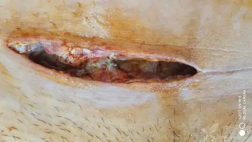 剖宫产术后5天,这样的感染切口怎么处理住院时间最短?