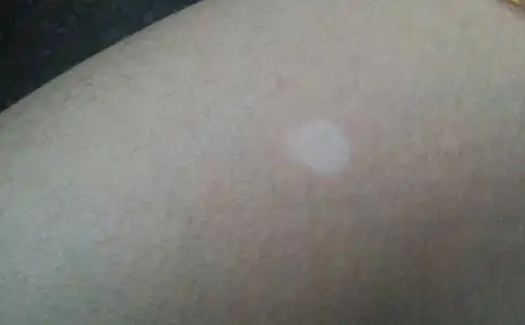 腿上长白斑是怎么回事?