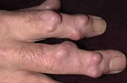 痛风早期症状图片 (57)
