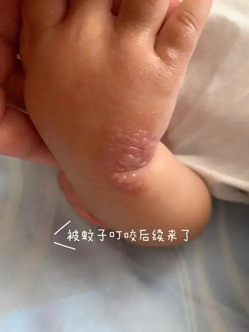 被毒蚊子咬伤几天后成了这样