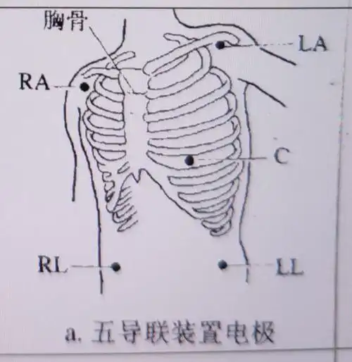 其它 心电监护仪(副本) 写美篇五个电极的安放位置: 右上(ra):胸骨右
