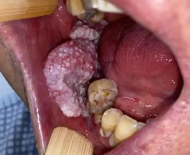 九院援疆干部助力科室走向快车道 喀什二院开展高难度口腔癌根治手术