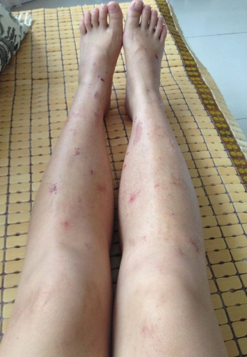 过敏皮炎症状图片61