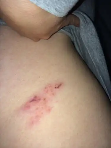 我这是被蜈蚣咬了吗? 昨天发现家里有只死掉的小蜈蚣